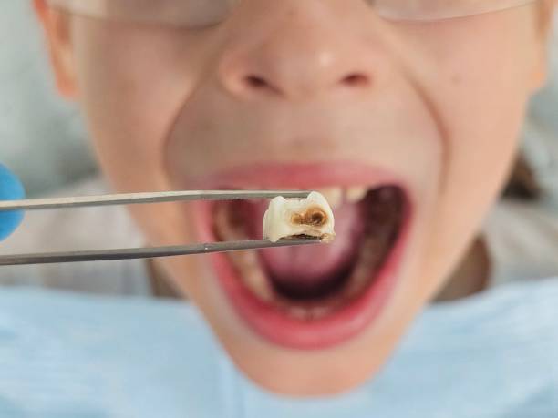 Best Emergency Treatment for Oral Infections in Richland, MS